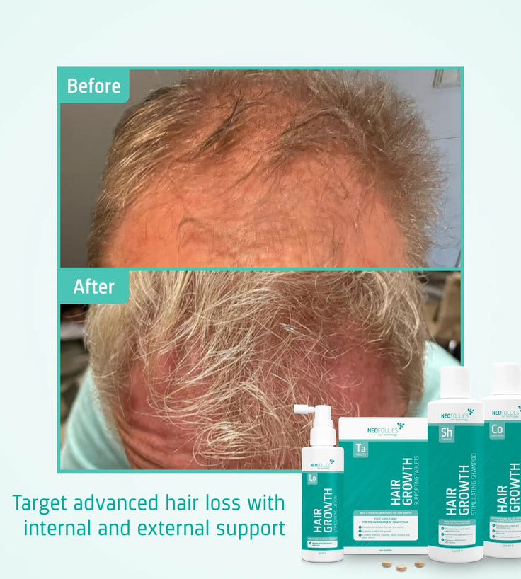 Neofollics Shampoo + Conditioner + Lotion + Tablets