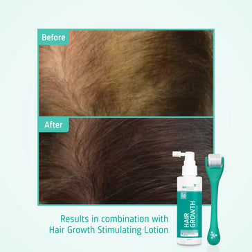 4x Neofollics Lotion + gratis Scalp Roller 4x Neofollics lotion + gratis scalp roller - Hairgivers