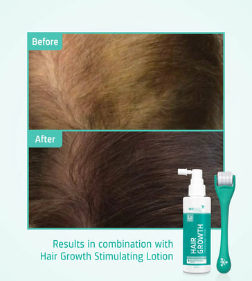 4x Neofollics Lotion + gratis Scalp Roller 4x Neofollics lotion + gratis scalp roller - Hairgivers