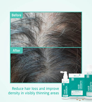 Neofollics Tablets + Shampoo + Lotion Behandeling voor matig mannelijk erfelijk haarverlies - Hairgivers