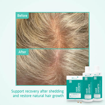 Neofollics Shampoo + Conditioner + Tablets Alopecia androgenetica behandeling (vrouw) - Hairgivers