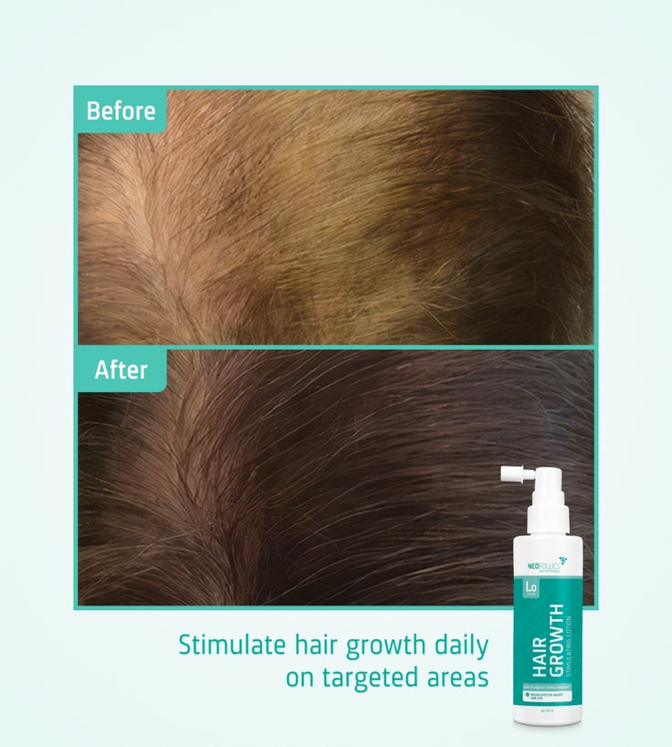 Neofollics Lotion haargroei serum (7% Neoxyl)