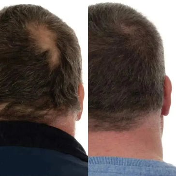 Foligain haargroei behandeling (man) Foligain haargroei behandeling (man) - Hairgivers