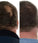 Foligain haargroei behandeling (man) - Hairgivers
