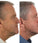 Foligain haargroei behandeling (man) - Hairgivers