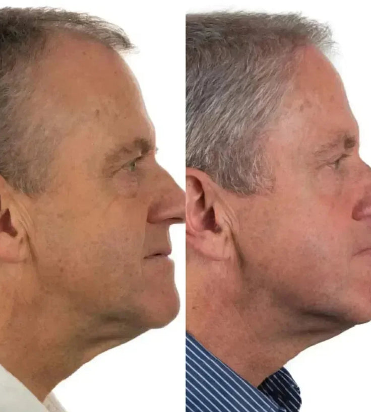 Foligain haargroei behandeling (man) - Hairgivers