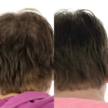Foligain haargroei behandeling (vrouw) Foligain haargroei behandeling (vrouw) - Hairgivers