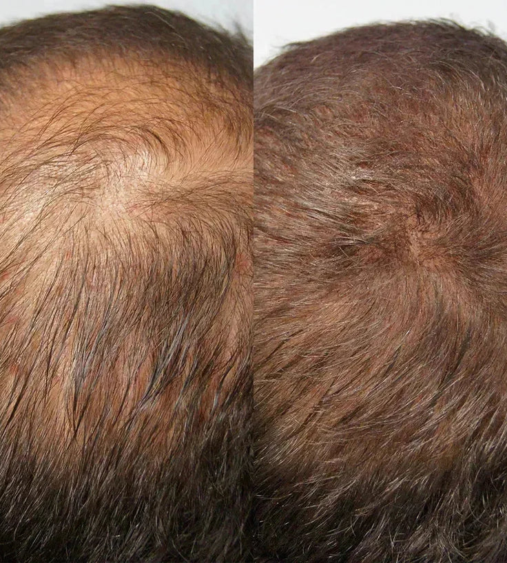 Kmax DHT blocker serum - Hairgivers