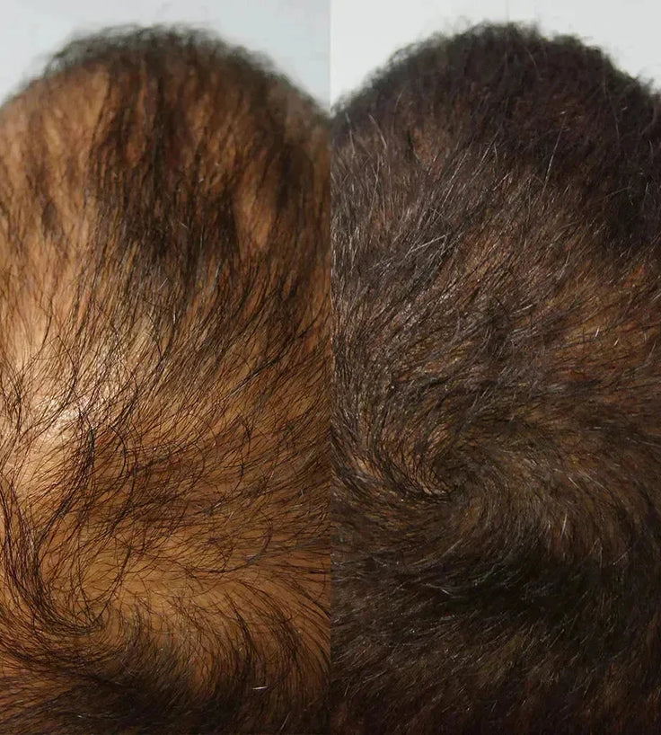 Kmax haaruitval follicle spray - Hairgivers