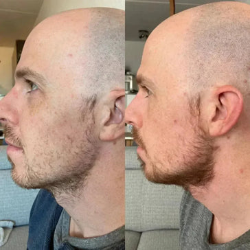 Neofollics baardgroei kit Neofollics baardgroei kit - Hairgivers