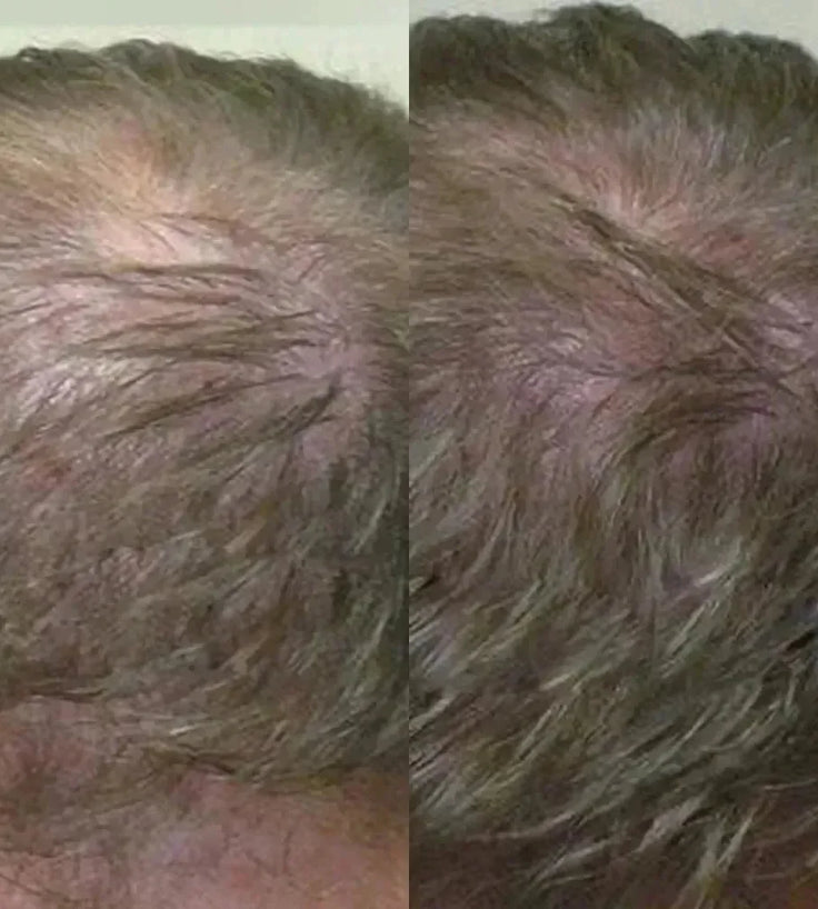 Neofollics haargroei shampoo + conditioner starter kit - Hairgivers