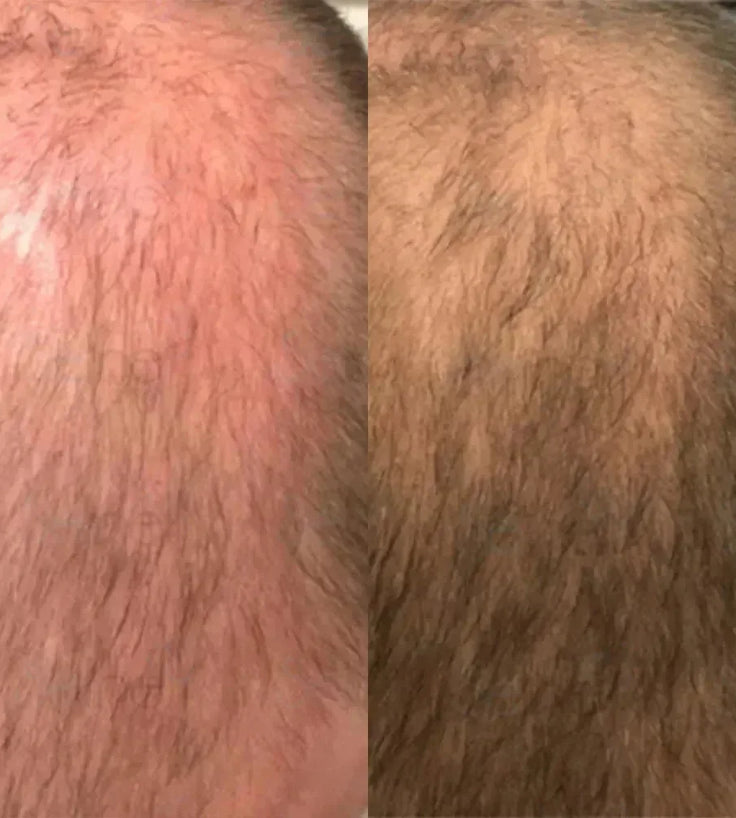 Panthrix haargroei serum 3-pack (Redensyl) - Hairgivers