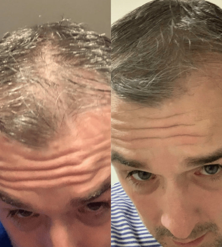 Scandinavian Biolabs Bio-Pilixin Hairline Booster navulling (3-pack)