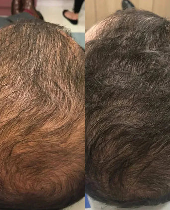 Spectral.DNC-N (Nanoxidil) lotion Spectral.DNC-N (Nanoxidil) lotion