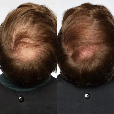 Theradome LH40 EVO laserhelm Theradome LH40 EVO laserhelm - Hairgivers