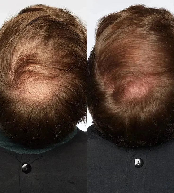 Theradome LH40 EVO laserhelm - Hairgivers