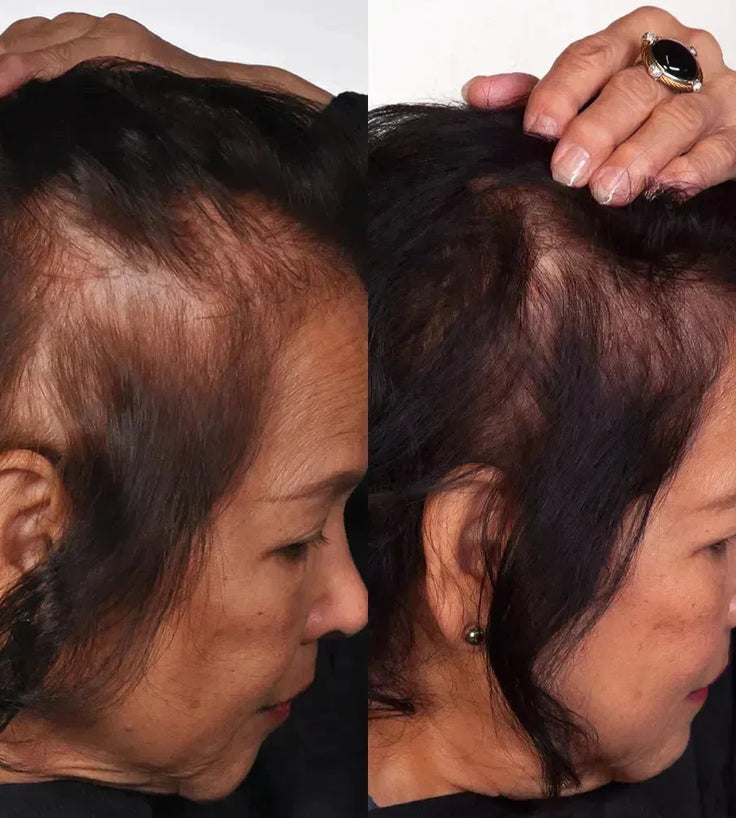 Theradome LH80 PRO laserhelm - Hairgivers