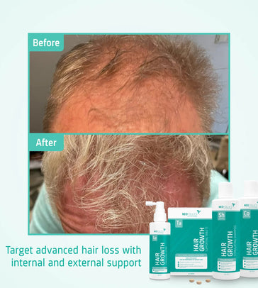 Behandeling voor gevorderd vrouwelijk erfelijk haarverlies - Hairgivers