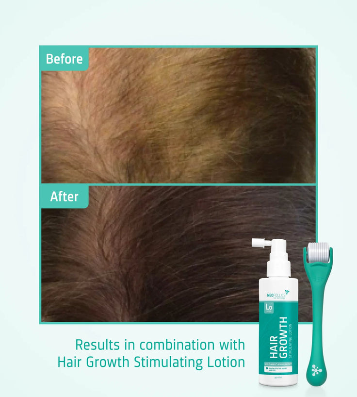 4x Neofollics Lotion + gratis Scalp Roller