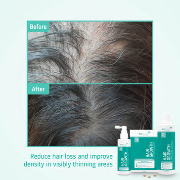 Behandeling voor matig mannelijk erfelijk haarverlies - Hairgivers
