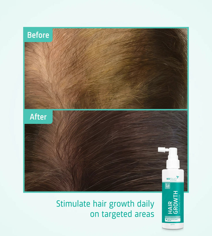 Neofollics Lotion haargroei serum 3-pack (7% Neoxyl)