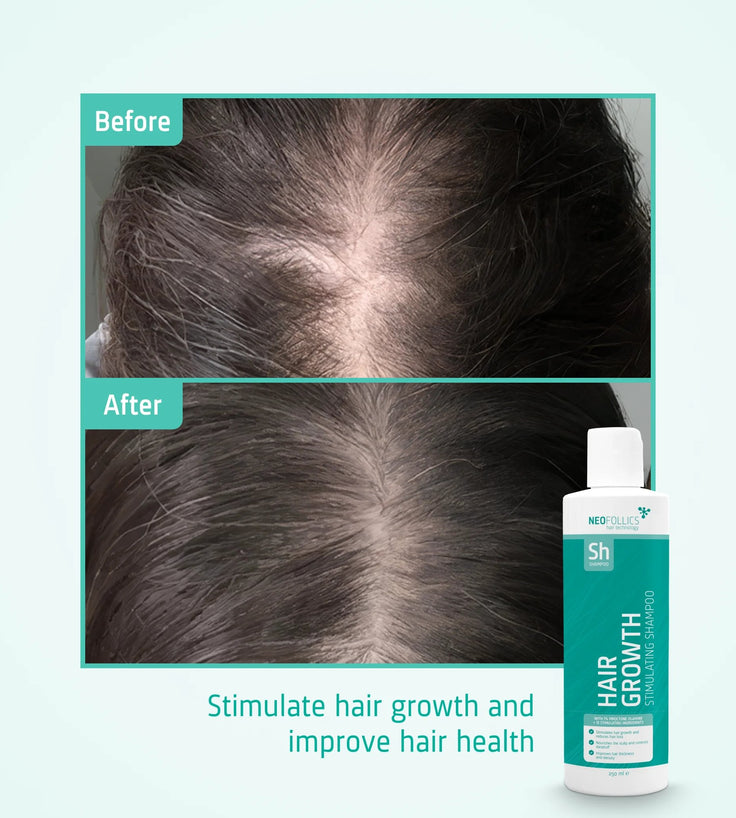 Neofollics Shampoo tegen haaruitval 3-pack (3x250 ml)