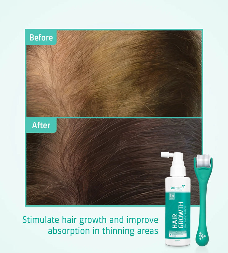 Neofollics Lotion + Scalp Roller