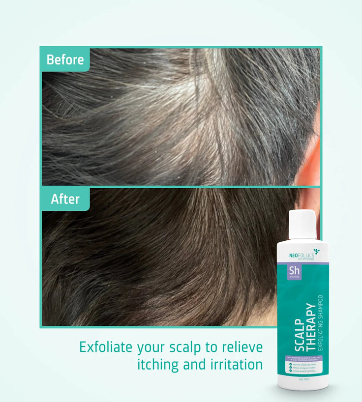 Neofollics Scalp Therapy Exfoliating Shampoo
