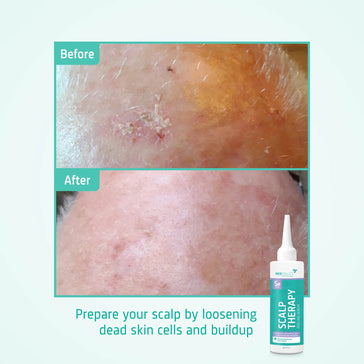 Neofollics scalp peeling serum - Hairgivers