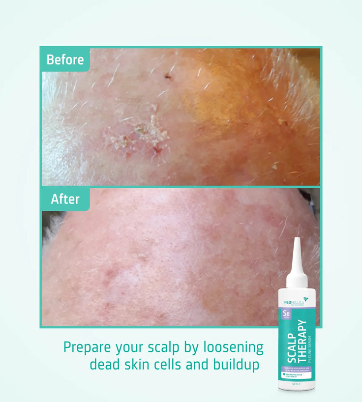 Neofollics Scalp Therapy Peeling Serum