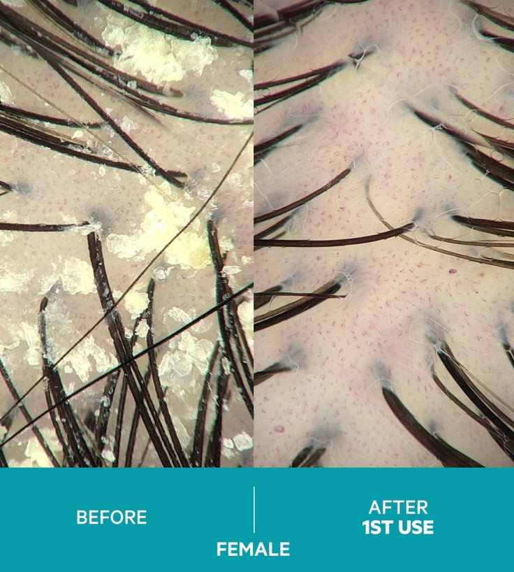 Dandrene anti-roos shampoo