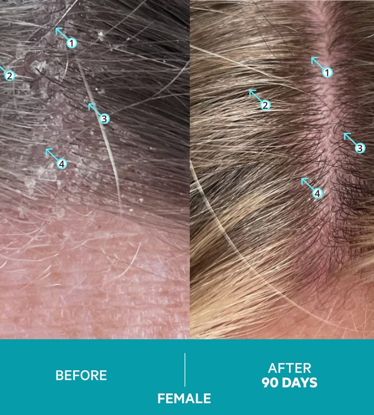 Dandrene anti-roos shampoo