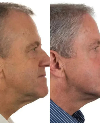 Foligain haargroei behandeling (man) - Hairgivers