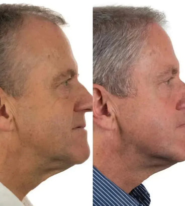 Foligain haargroei behandeling (man) - Hairgivers