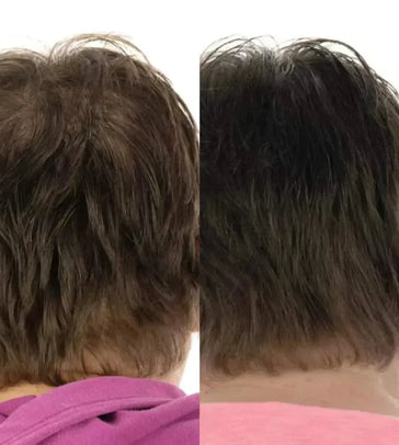Foligain haargroei behandeling (vrouw) - Hairgivers