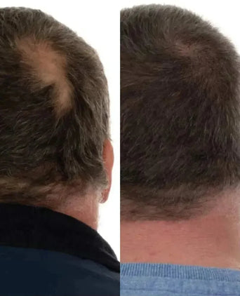 Foligain lotion man (10% Trioxidil) - Hairgivers