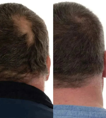 Foligain lotion man (10% Trioxidil) - Hairgivers
