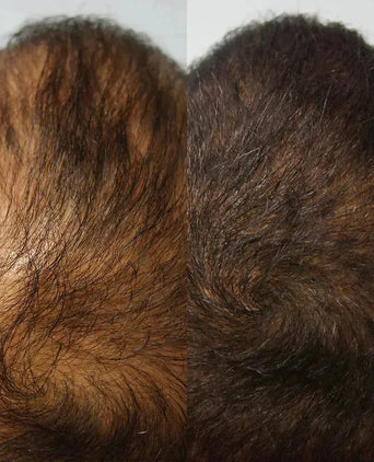 Kmax DHT blocker supplement - Hairgivers
