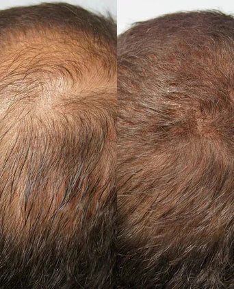 Kmax DHT blocker supplement - Hairgivers