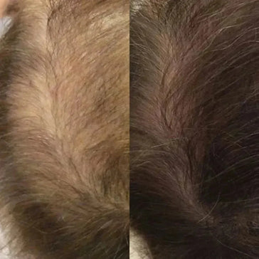 Neofollics haargroei lotion 3-pack (7% Neoxyl) - Hairgivers