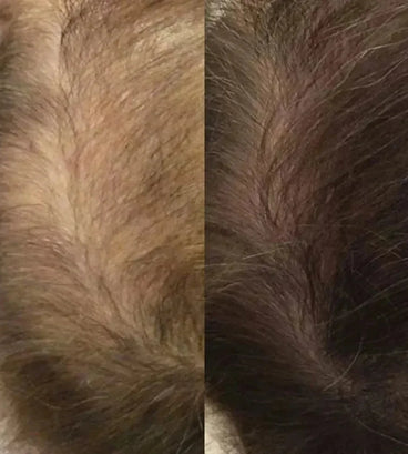 Neofollics haargroei lotion 3-pack (7% Neoxyl) - Hairgivers