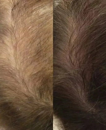 Neofollics haargroei lotion (7% Neoxyl) - Hairgivers