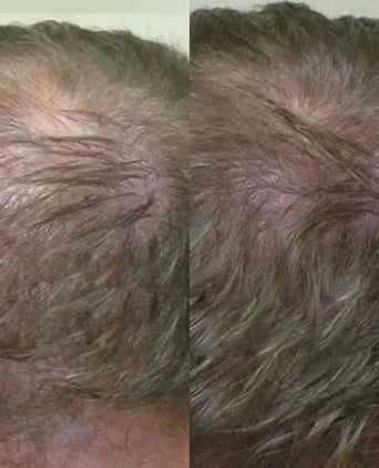 Neofollics haargroei shampoo + conditioner starter kit - Hairgivers