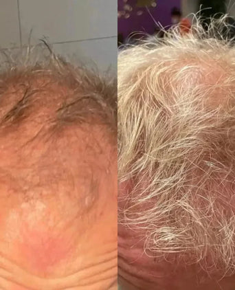 Neofollics hair growth tablets - Hairgivers