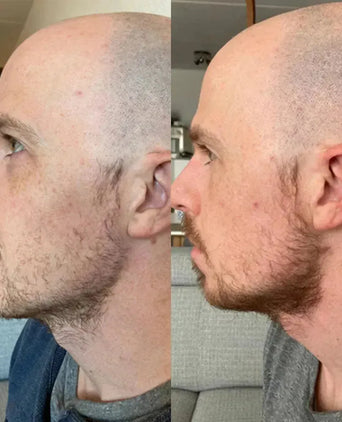Neofollics baardgroei serum (7% Neoxyl)
