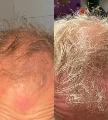 Neofollics haargroei shampoo + conditioner starter kit