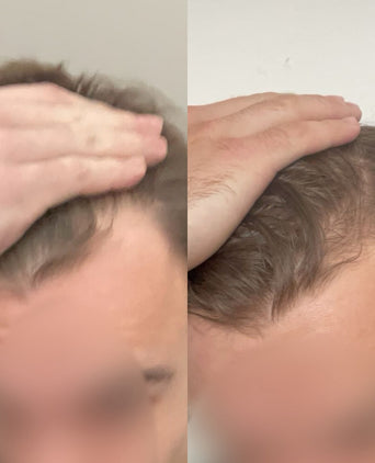 Scandinavian Biolabs Bio-Pilixin Hairline Booster