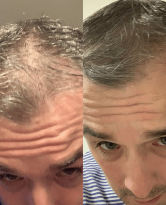 Scandinavian Biolabs Bio-Pilixin Hairline Booster navulling (3-pack)