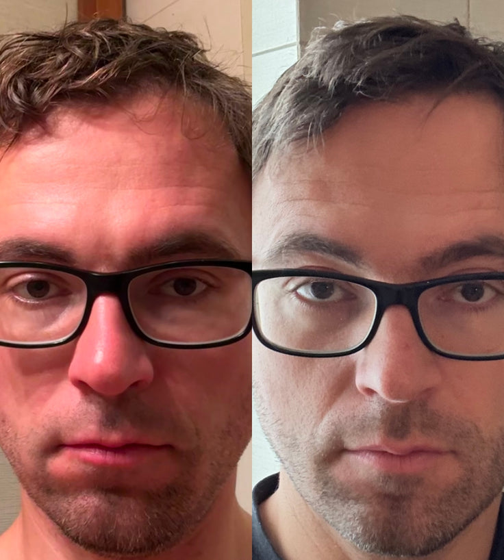 Scandinavian Biolabs Bio-Pilixin Hairline Booster navulling (3-pack)