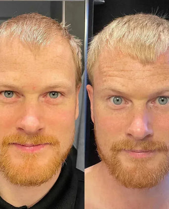 Scandinavian Biolabs haargroei behandeling (man) - Hairgivers